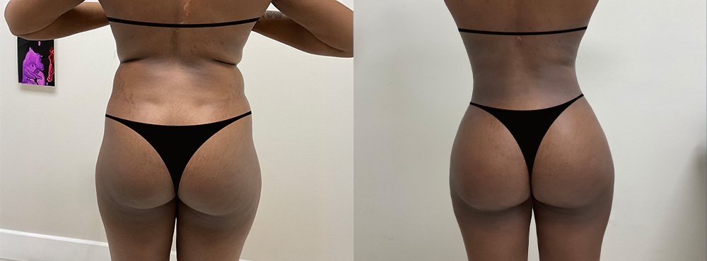 Butt Lift Before and After