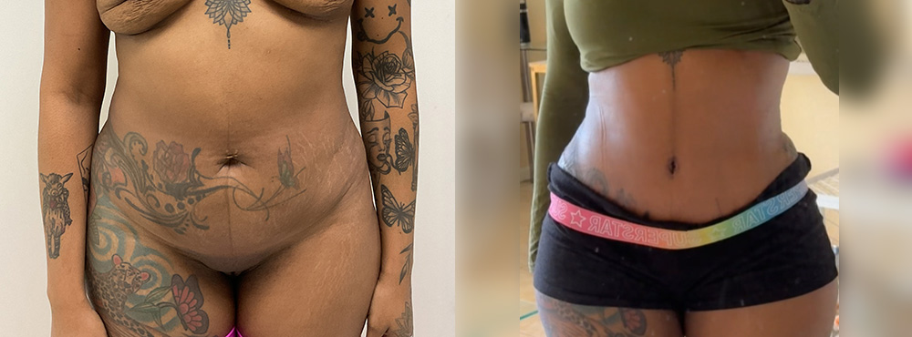 Tummy Tuck before and after