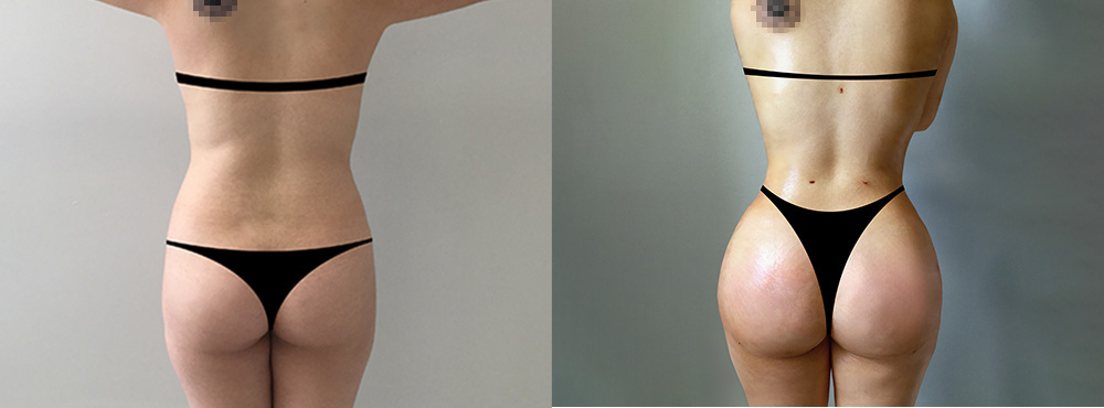 Brazilian Butt Lift Before and After