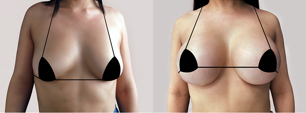 Breast Augmentation Before and After 