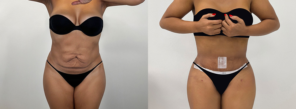 Brazilian Butt Lift Before and After
