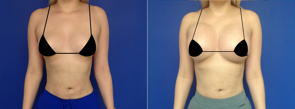 Breast Augmentation before and After
