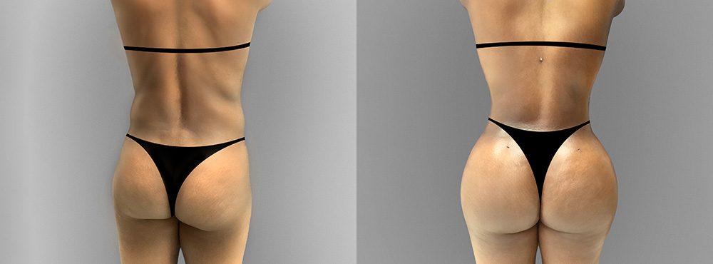 Brazilian Butt Lift Before and After