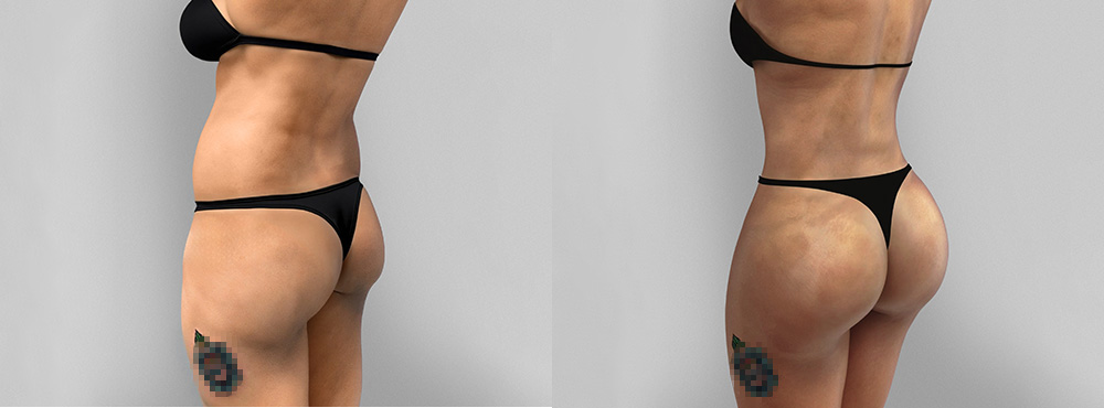 Butt Lift Before and After in Miami