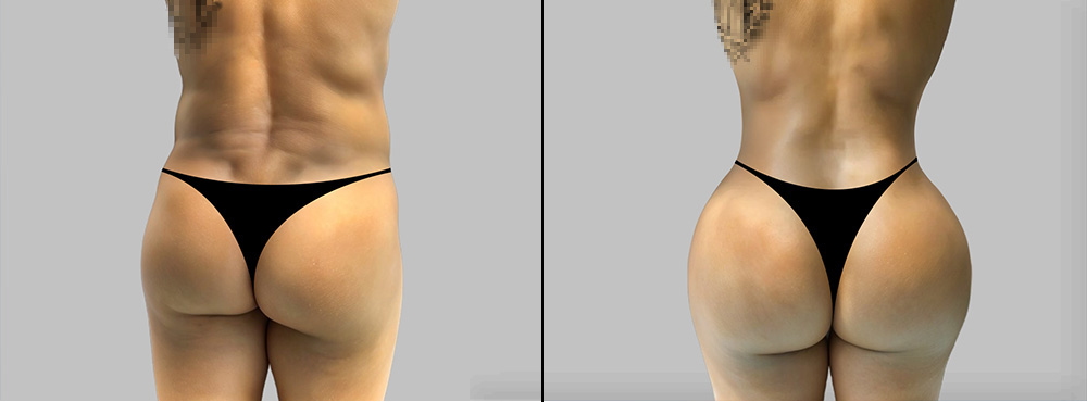 Brazilian Butt Lift Before and After