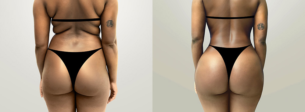 Butt Lift Before and After in Miami