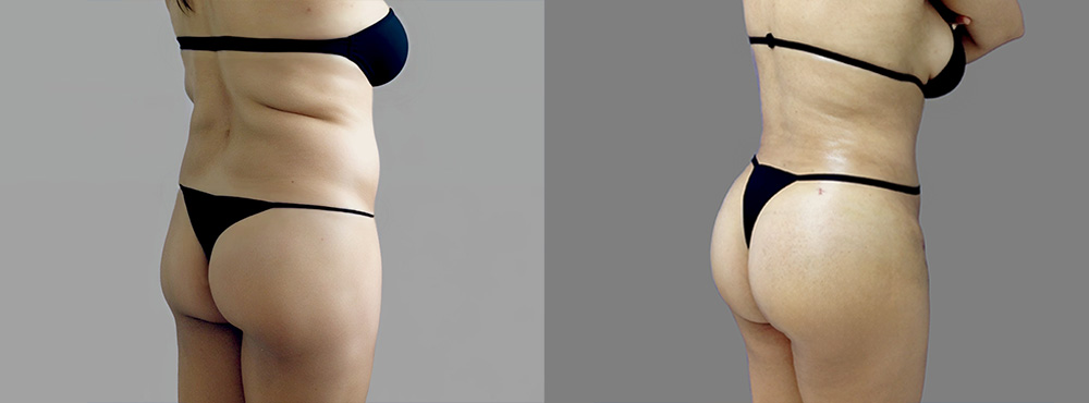 Brazilian Butt Lift Before and After