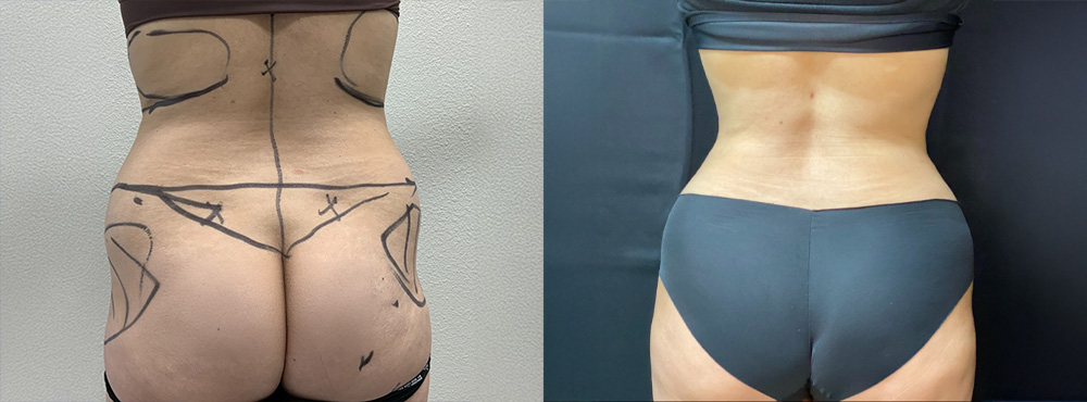 Liposuction Before and After