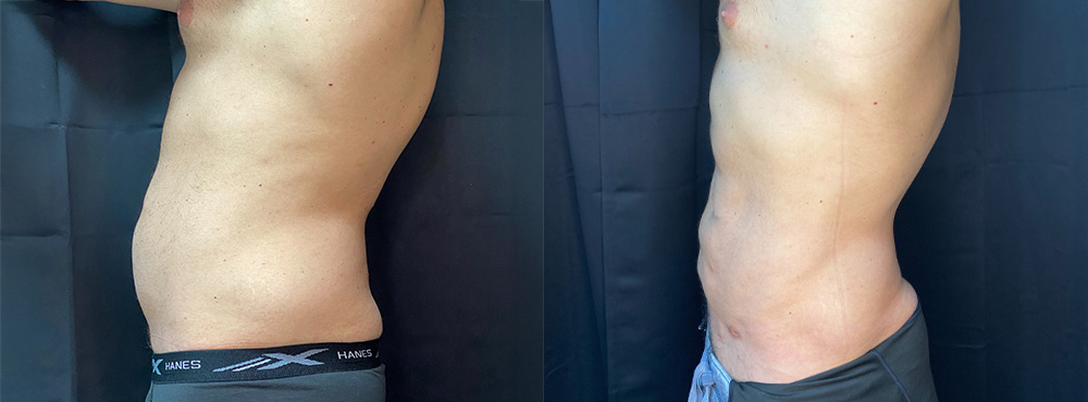 Men Lipo Before and After