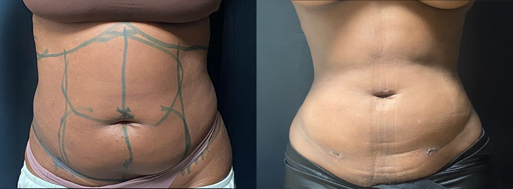 Liposuction Before and After