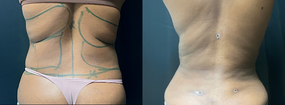 Liposuction Before and After