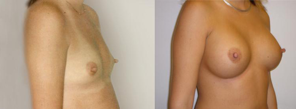 Breast Augmentation before and after