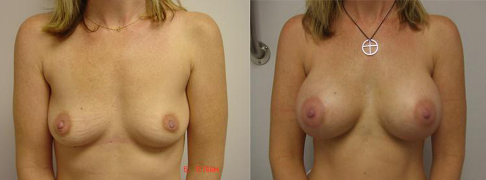 Breast Augmentation Before and After