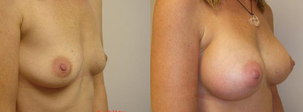 Breast Augmentation Before and After