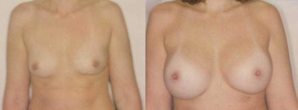 Breast Augmentation Before and After