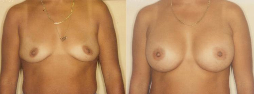 Breast Augmentation Before and After