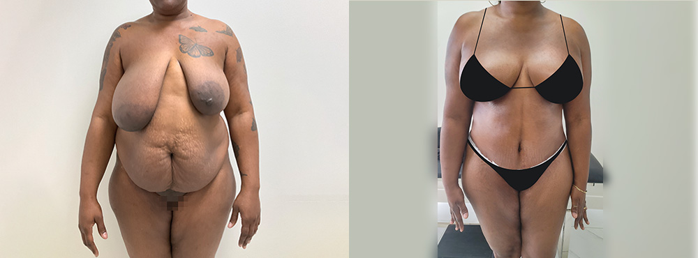 Mommy Makeover Before and After