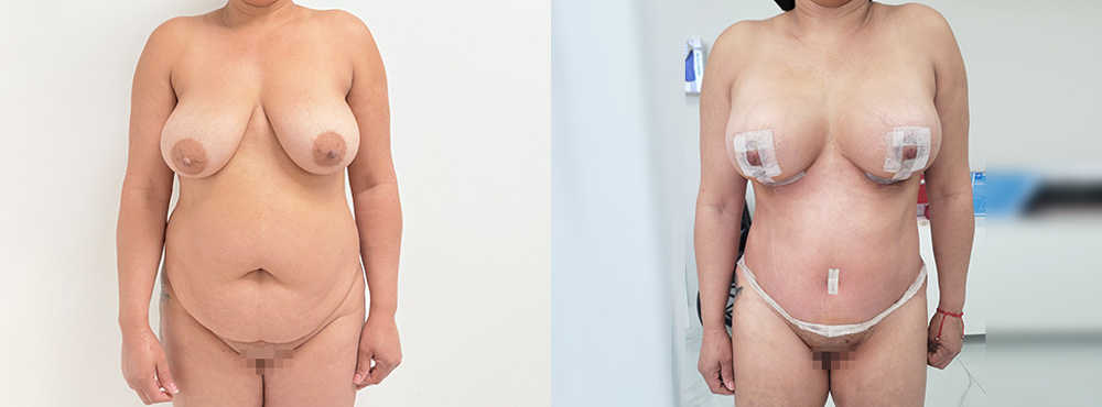 Mommy Makeover Before and After