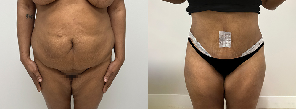 Tummy Tuck Before and After