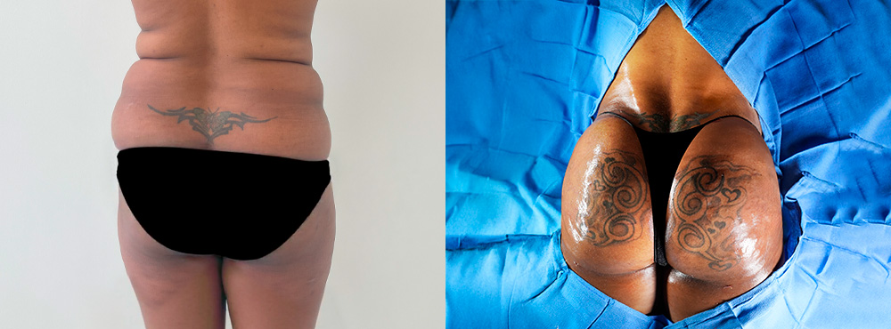 Brazilian Butt Lift Before and After