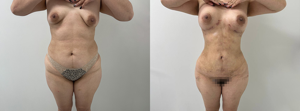 Butt Lift Before and After