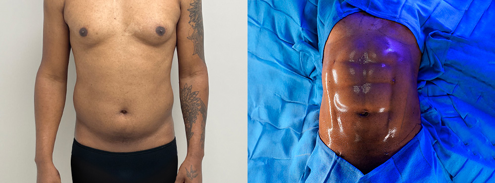 Abdominal Etching Before and After