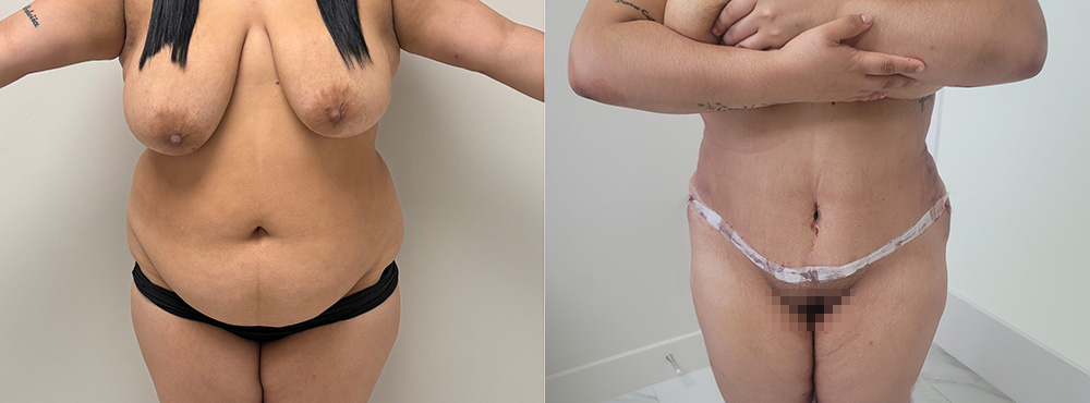 tummy tuck before and after