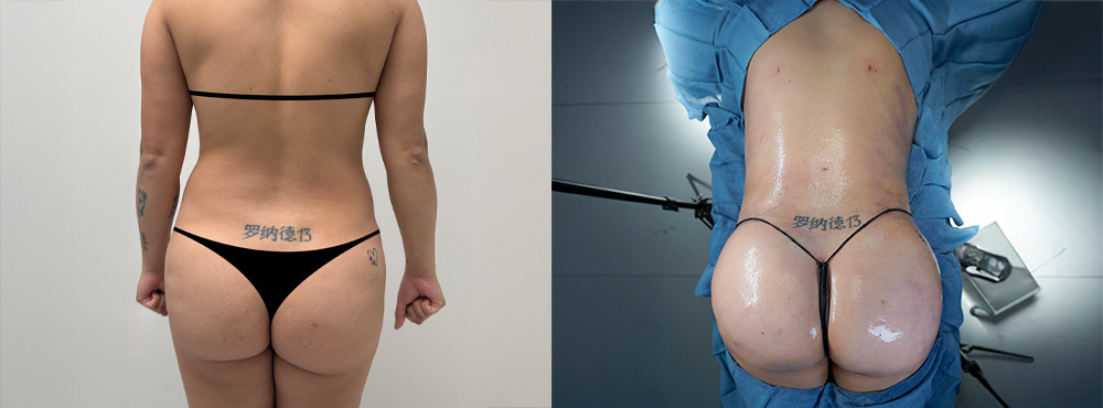 Brazilian Butt Lift Before and After