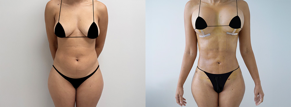 Breast Lift Before and After