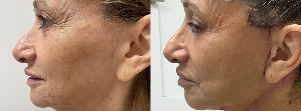 Neck Lift Before and After