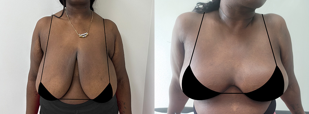 Breast Reduction Before and After
