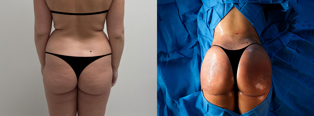 Brazilian Butt Lift Before and After