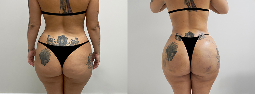 Brazilian Butt Lift Before and After in Miami