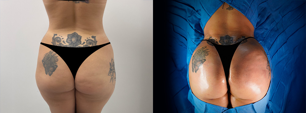 Brazilian Butt Lift Before and After