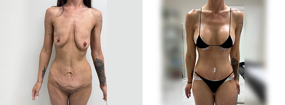 Mommy Before and After