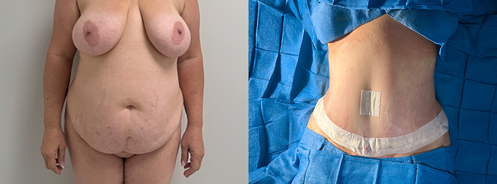 Tummy Tuck Before and After in miami