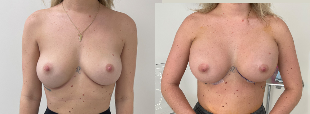 Breast Augmentation before and after