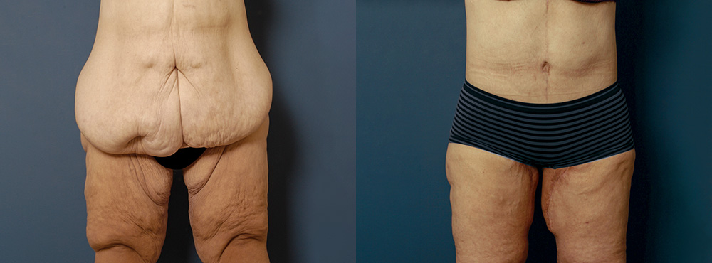Tummy Tuck Before and After