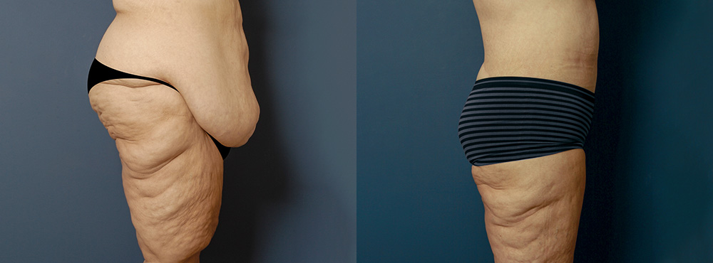 Tummy Tuck Before and After