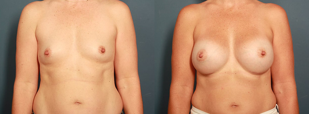 Breast Augmentation Before and After