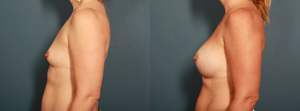 Breast Augmentation Before and After