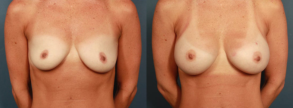 Breast Augmentation Before and After in Miami