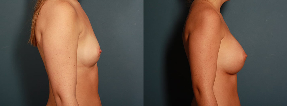 Breast Agmentation before and after