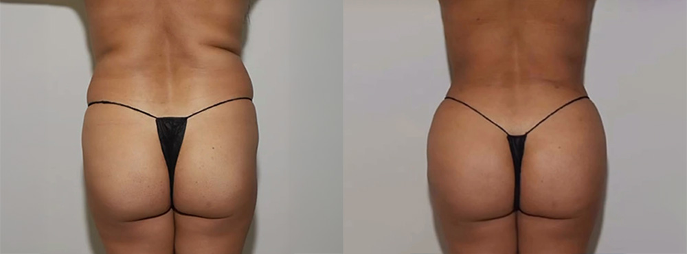 Butt Lift Before and After in Miami