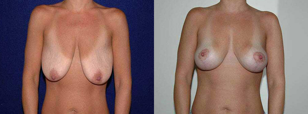 Breast Lift Before and After