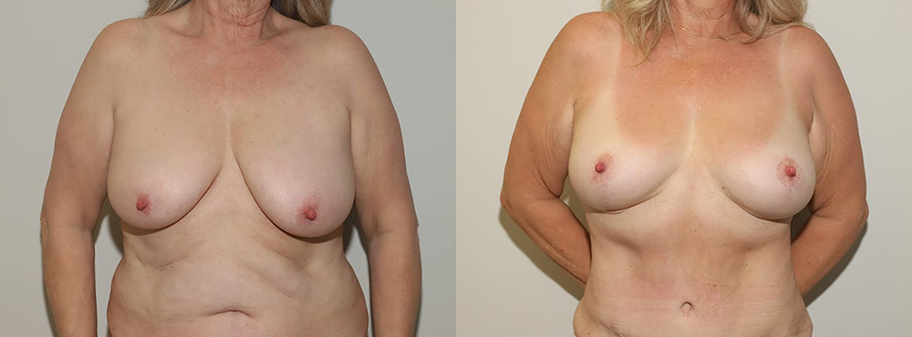 Breast Lift Before and After
