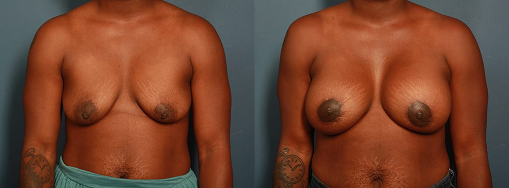 Breast Lift Before and After