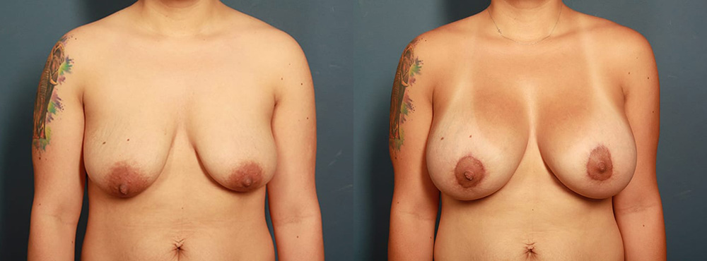 Breast Lift Before and After in Miami