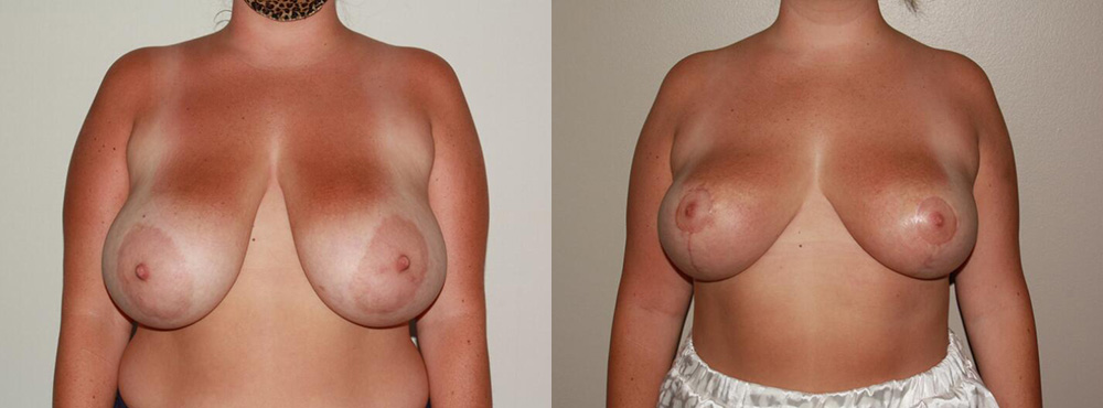 Breast Reduction Before and After in Miami