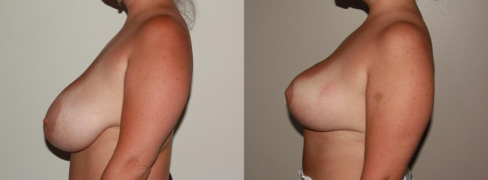 Breast Reduction Before and After in Miami